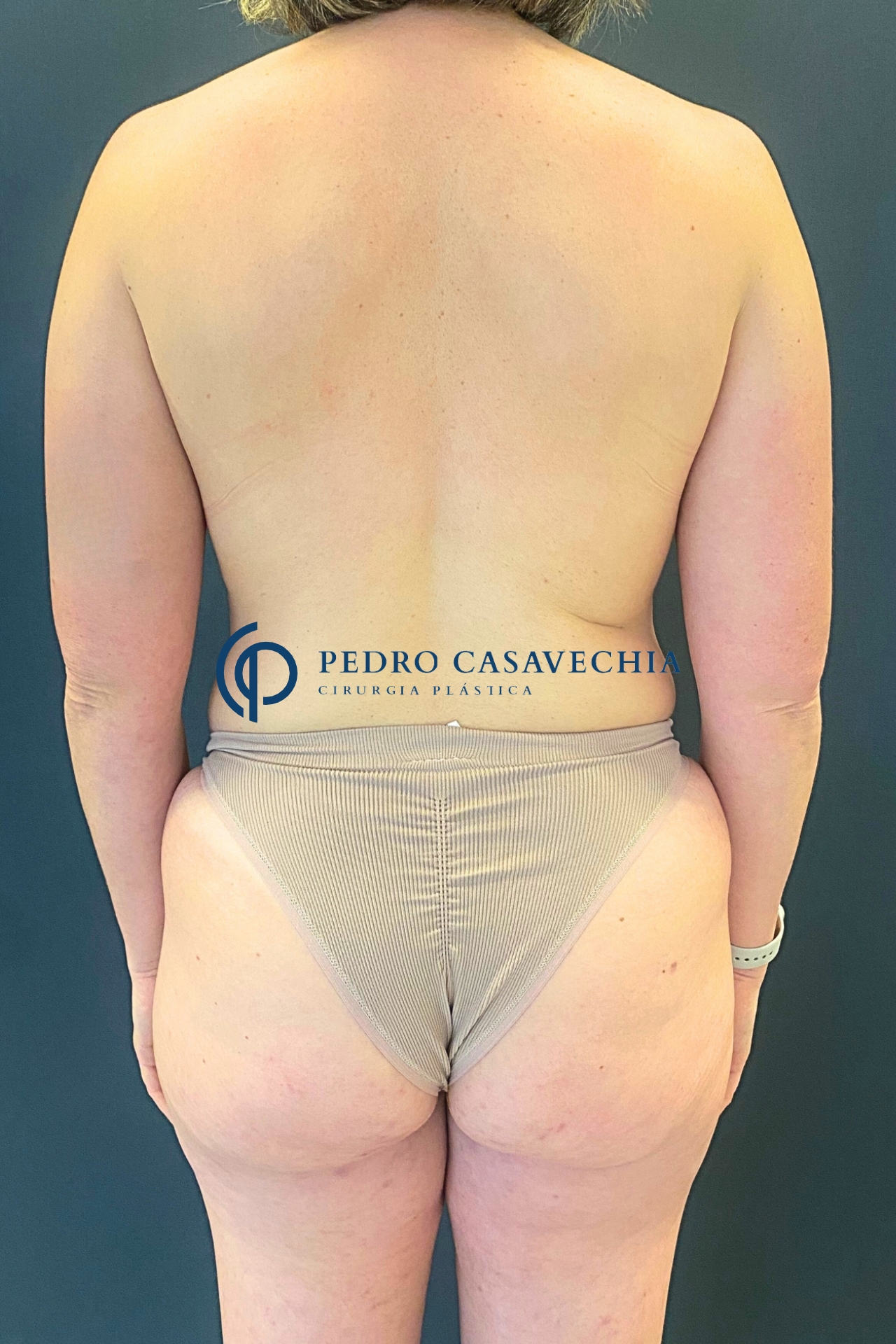 Antes do procedimento de Mommy Makeover