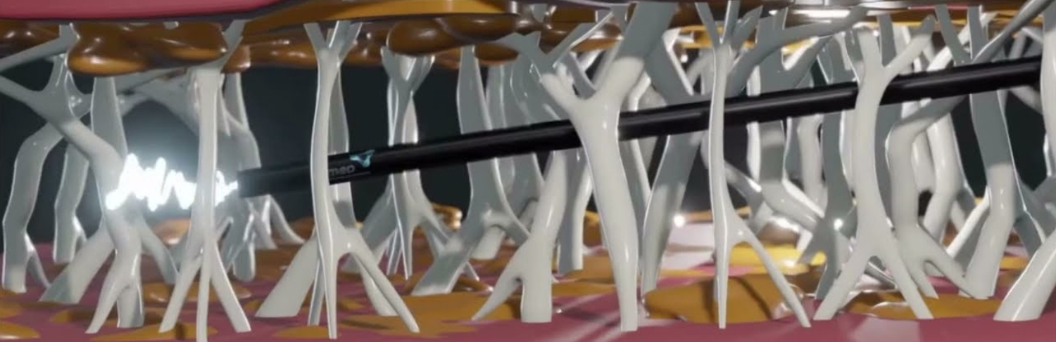 Procedimento de Lipo Ultrassônica, exemplo.