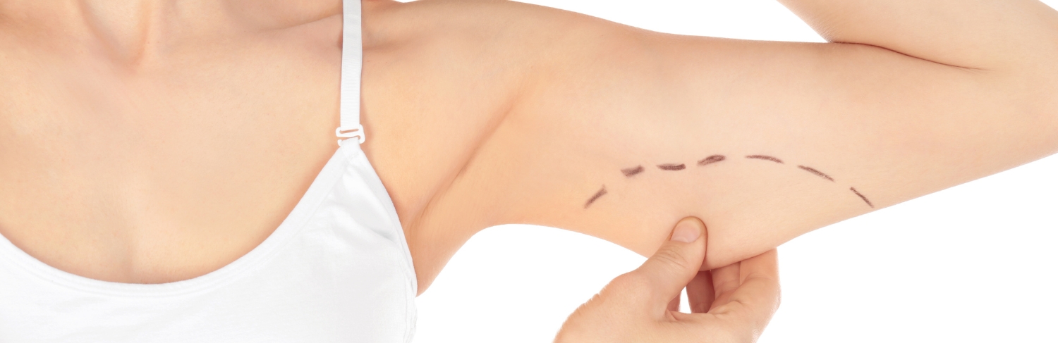 Imagem ilustrativa de braquioplastia