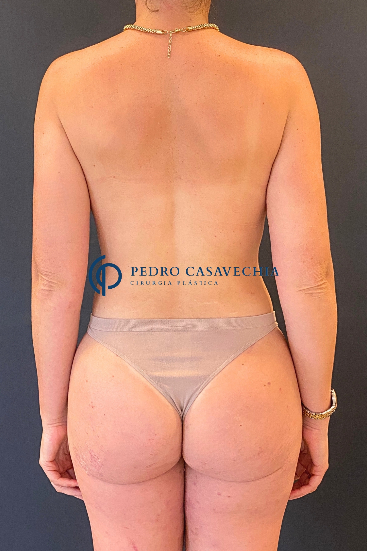 Depois do procedimento de Mommy Makeover