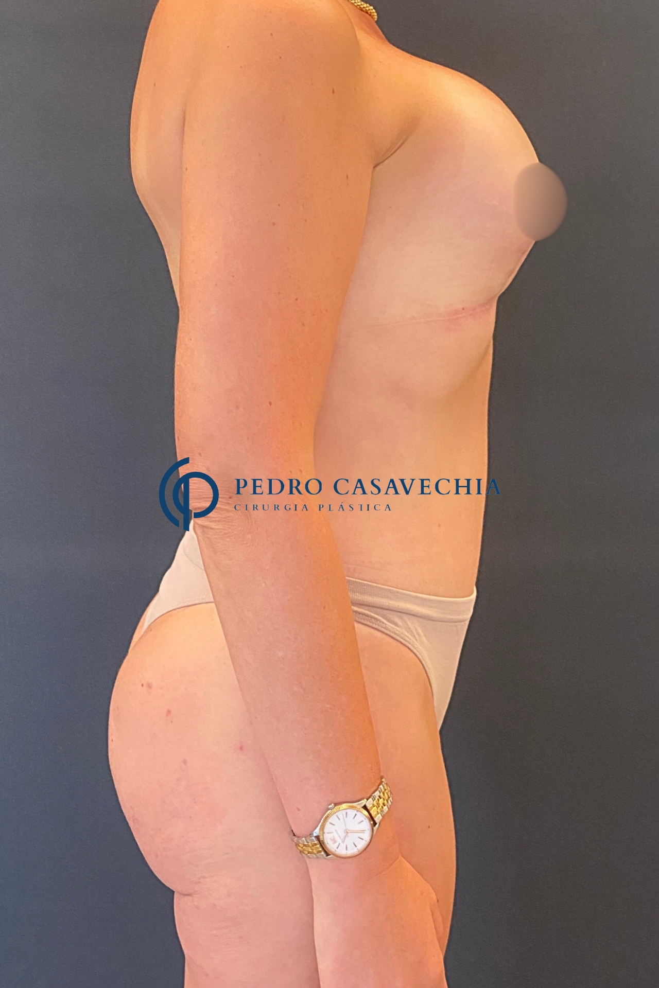 Depois do procedimento de Mommy Makeover