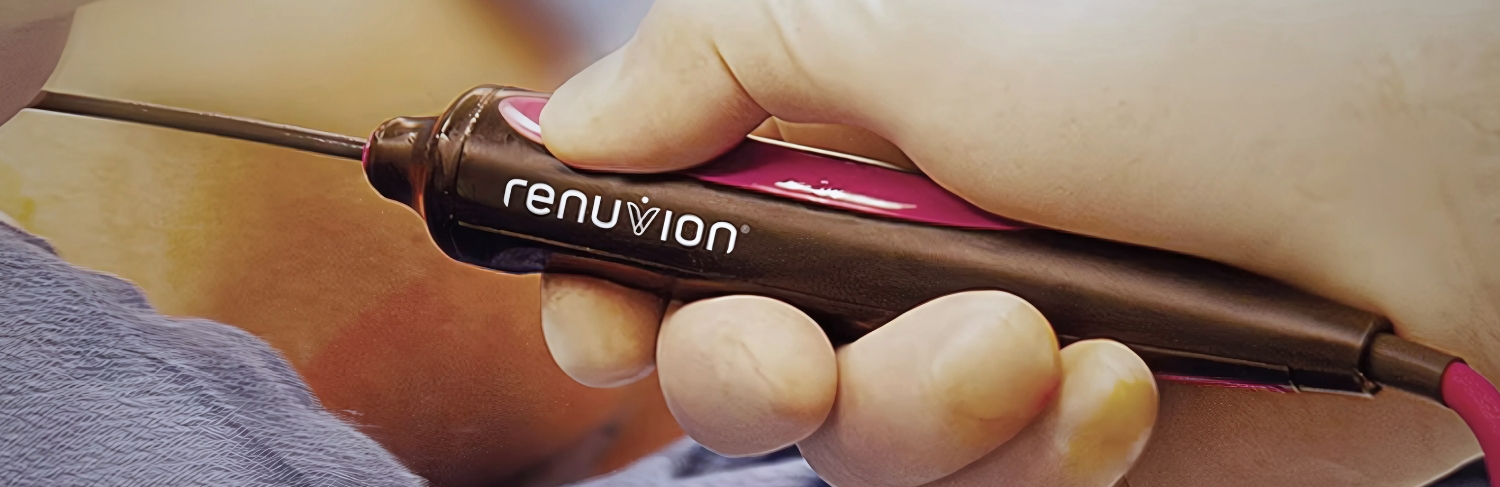 Renuvion, equipamento de alta tecnologia para procedimentos de contorno corporal.